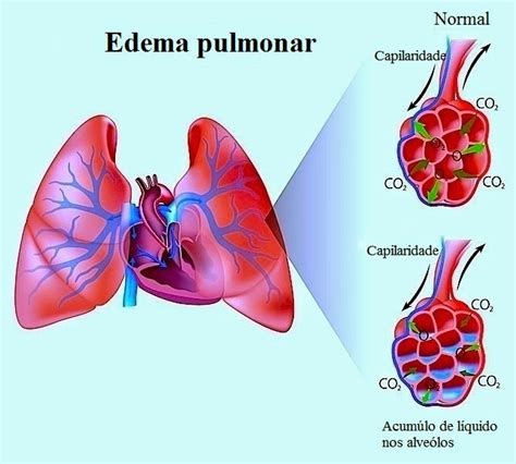 edema agudo de pulmão-1